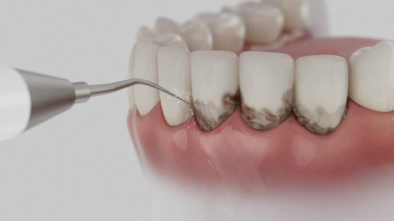 Reliable Dental Implants contractor in Pinecrest, FL by Smile Center Dentistry